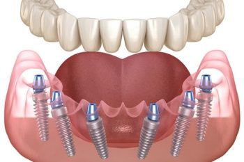 All-On-6-Dental-Implants