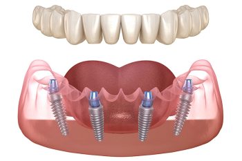 All-on-4-dental-implants